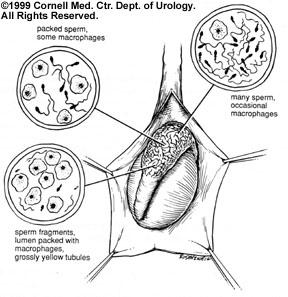 Non-Obstructive Azoospermia
